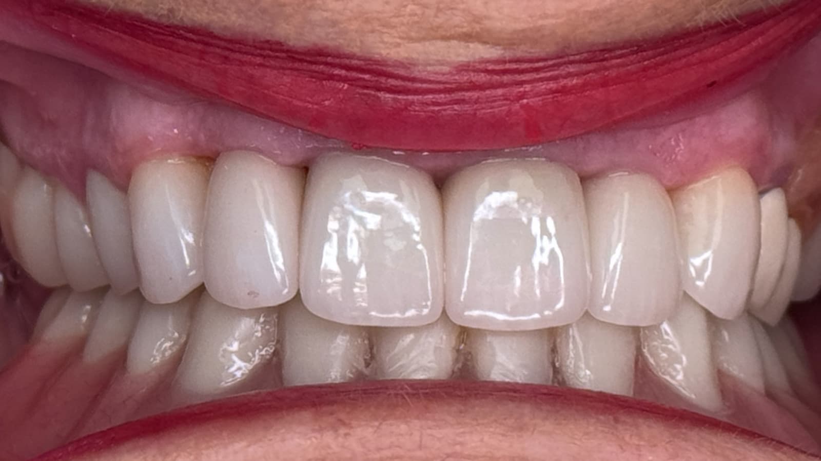 Close-up of a healthy smile showcasing bright, white teeth and healthy gums after treatment at SoCal Prime Dentistry in Rancho Santa Margarita, CA.