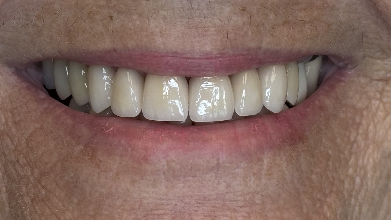 Close-up of a smiling mouth showcasing healthy, white teeth after cosmetic dentistry at SoCal Prime Dentistry.
